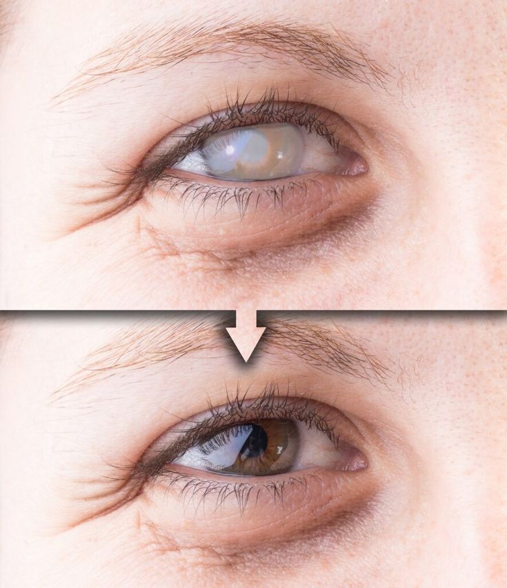 Cataract Surgery in Vadodara at Sattva Eye Hospital